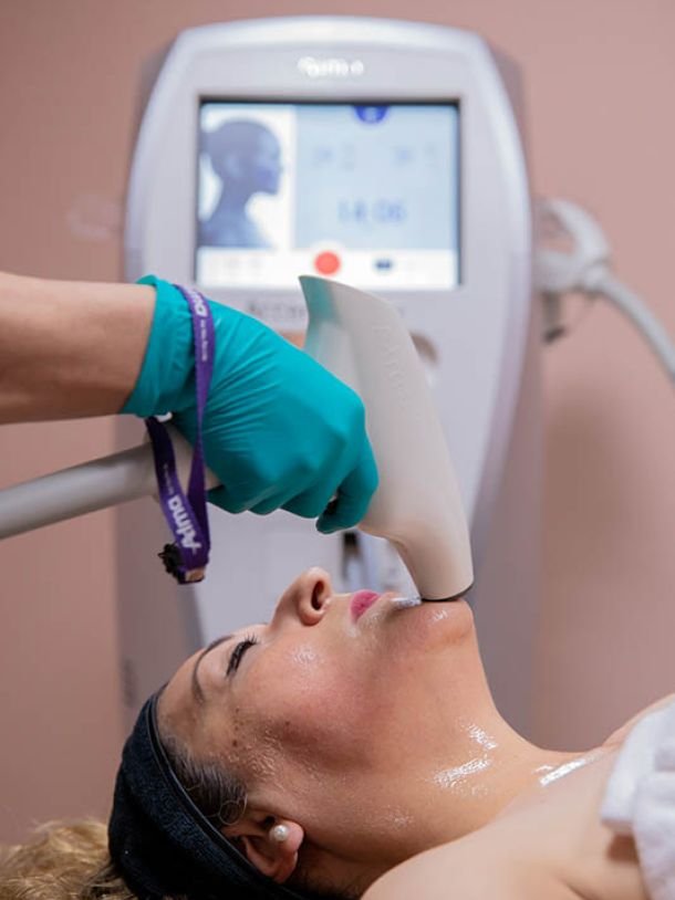 Accent XL Radiofrecuencia en Rostro | New Face & Body Mexicali