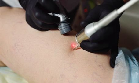 Tratamiento para várices en New Face & Body