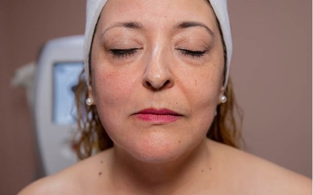 Accent XL Radiofrecuencia en Rostro | New Face & Body Mexicali